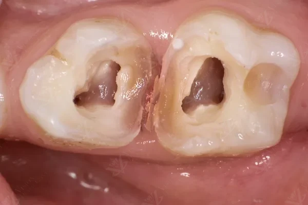 After pulpectomy restoration