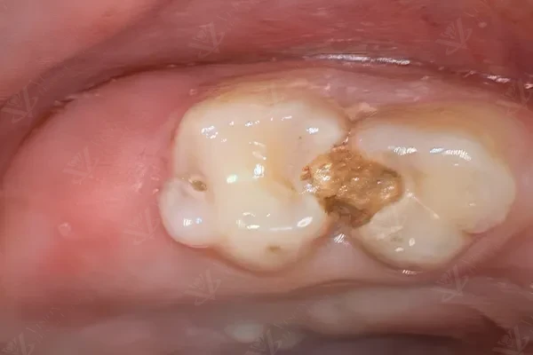 Before pulpectomy treatment