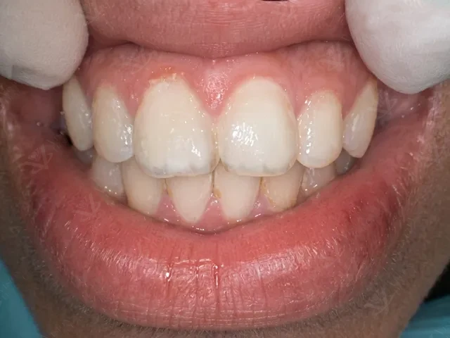 After dental restoration