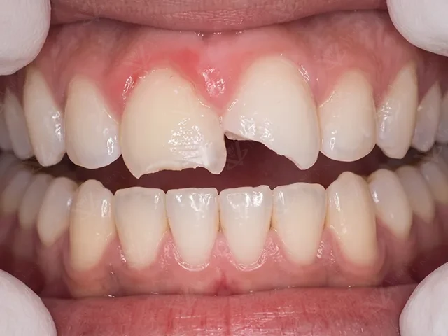Before dental restoration