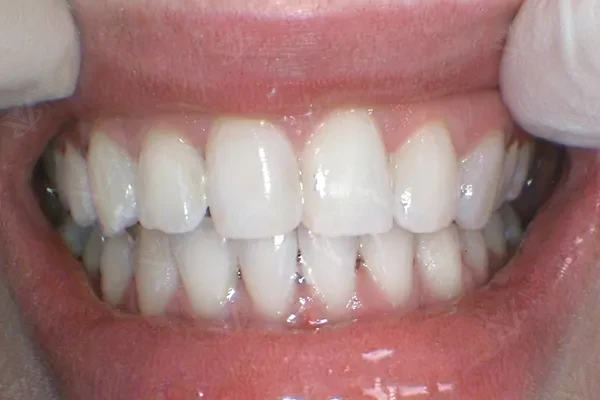 After Zoom teeth whitening result at Vision Dental Abu Dhabi