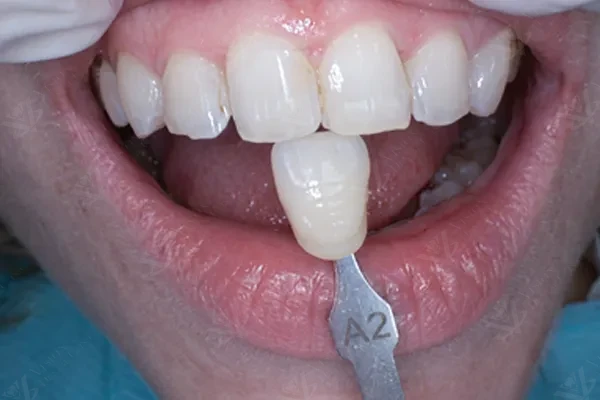 Before professional teeth whitening at Vision Dental Abu Dhabi