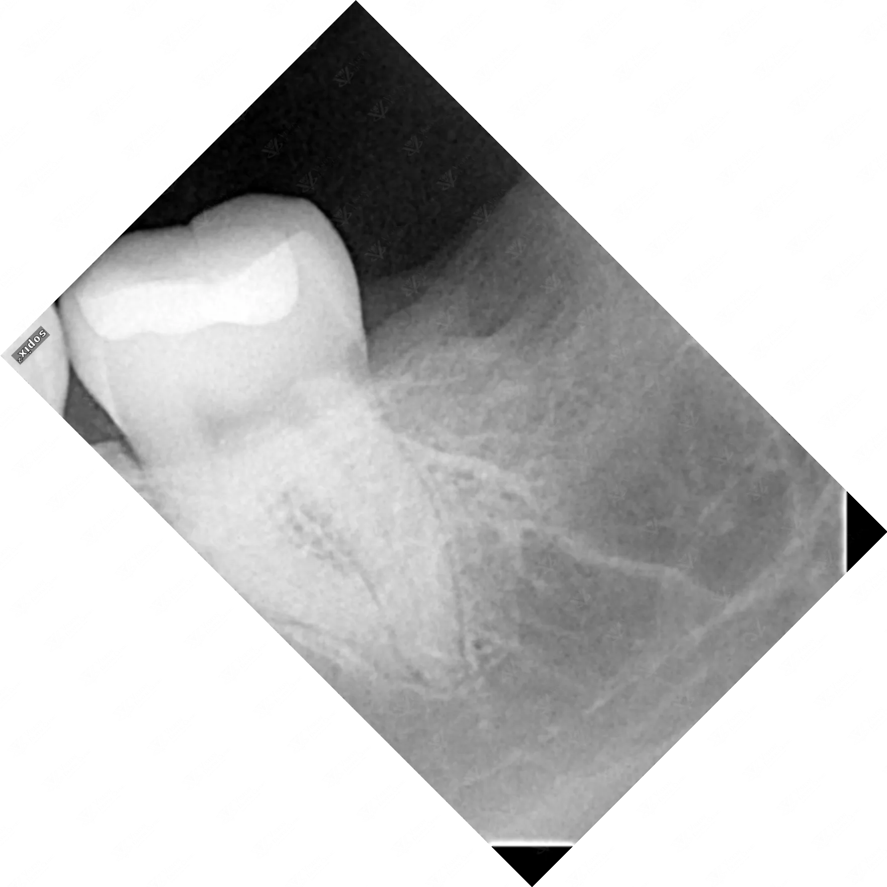 X-ray assessment for wisdom tooth surgical extraction