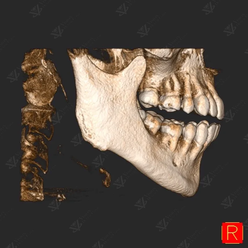 CBCT 3D scan for wisdom tooth extraction surgical planning