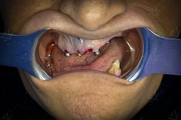 Before treatment — initial condition showing severe tooth loss