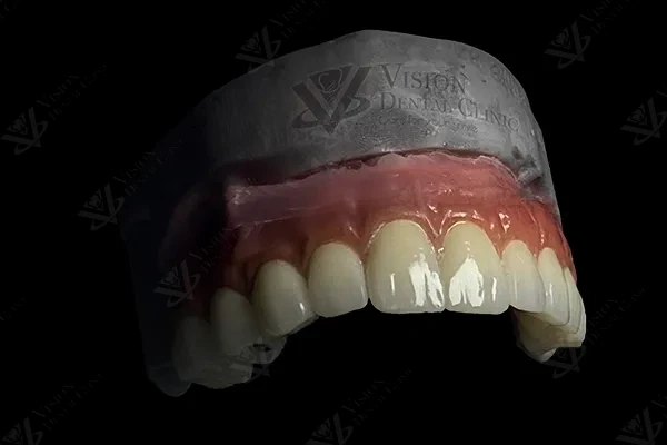 Upper arch prosthesis try-on with 3D printed model