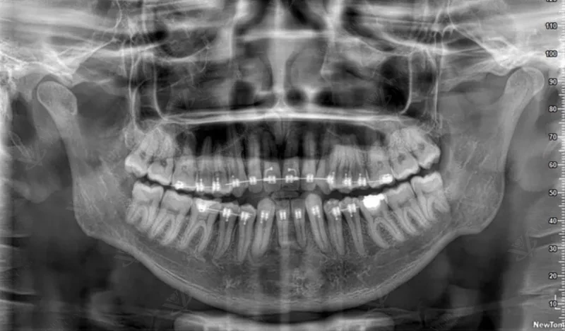 OPG panoramic X-ray showing orthodontic brackets and wisdom tooth assessment