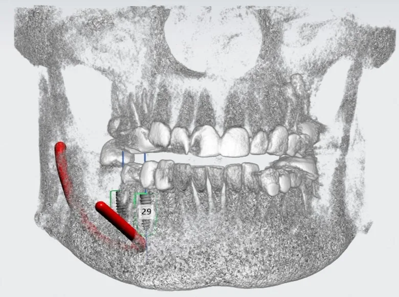 CBCT scan for dental phobic patient implant treatment under sedation