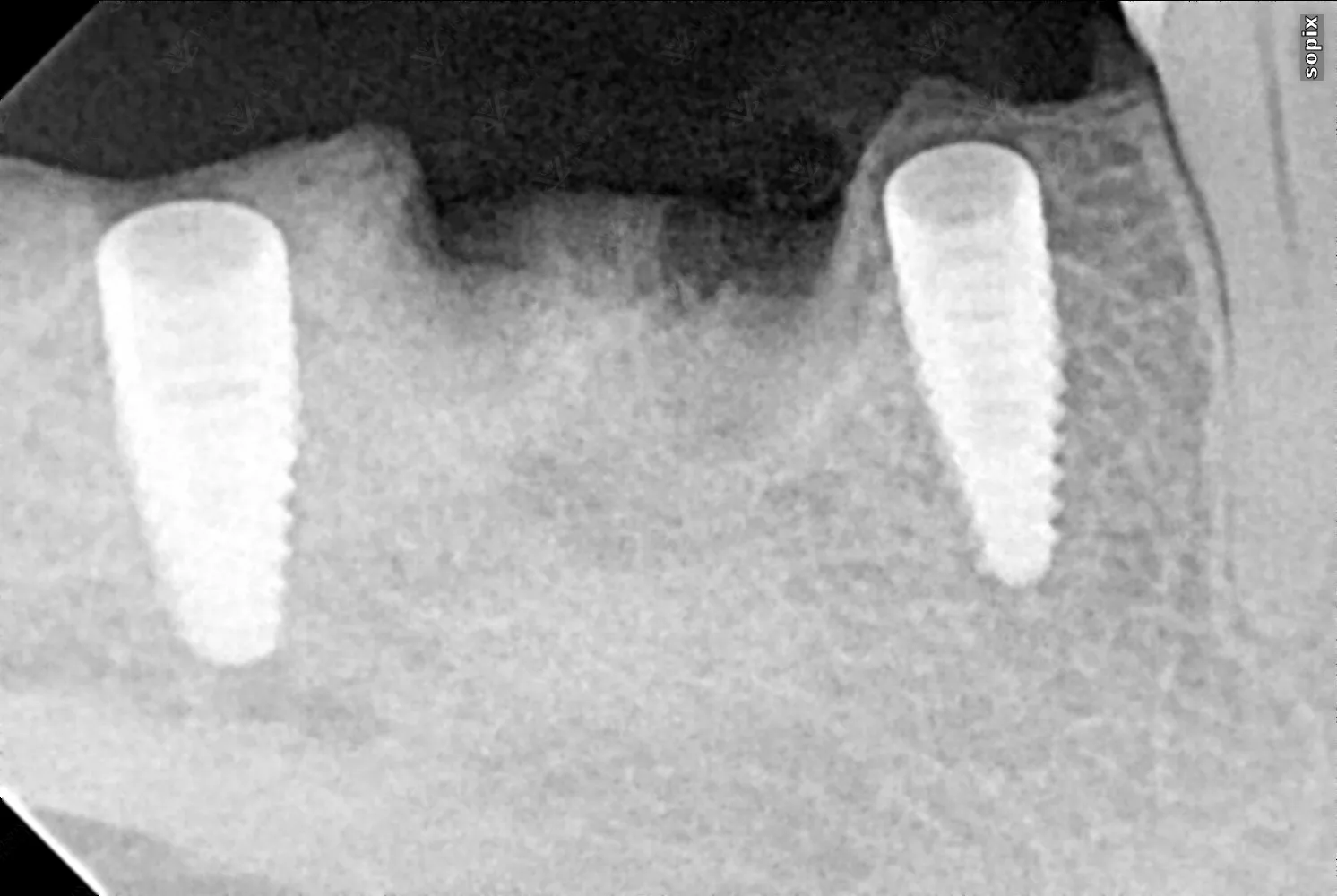 Chairside X-ray — dental implant placement verification Abu Dhabi