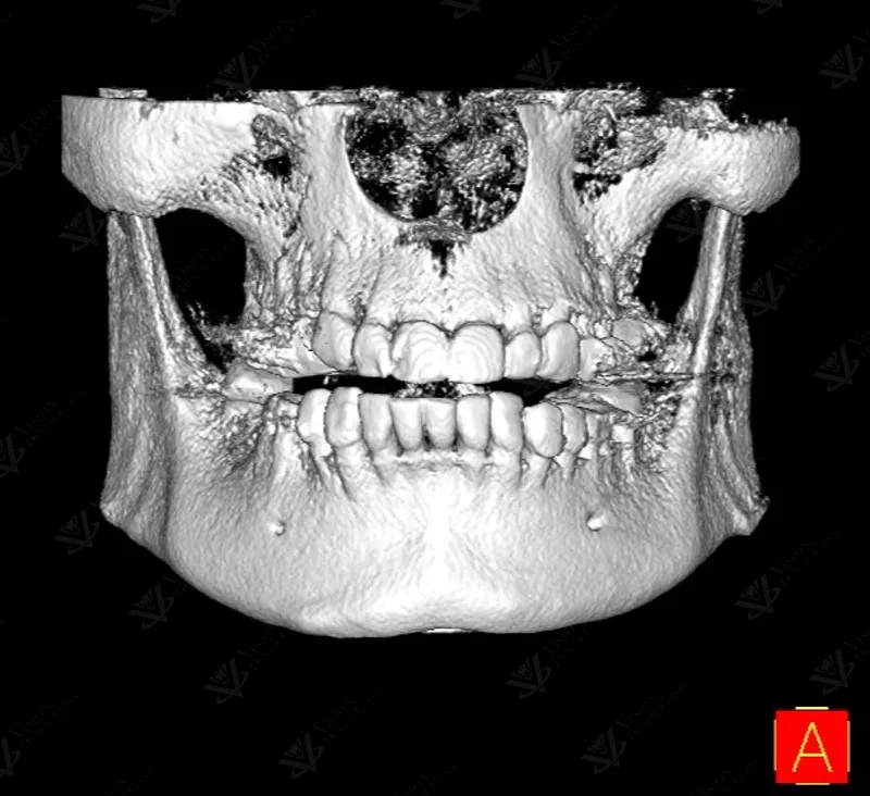 CBCT 3D cone beam scan for dental implant planning Abu Dhabi