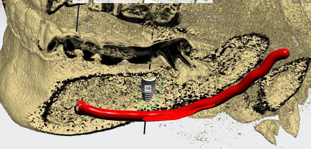 CBCT scan for full mouth dental implant rehabilitation planning