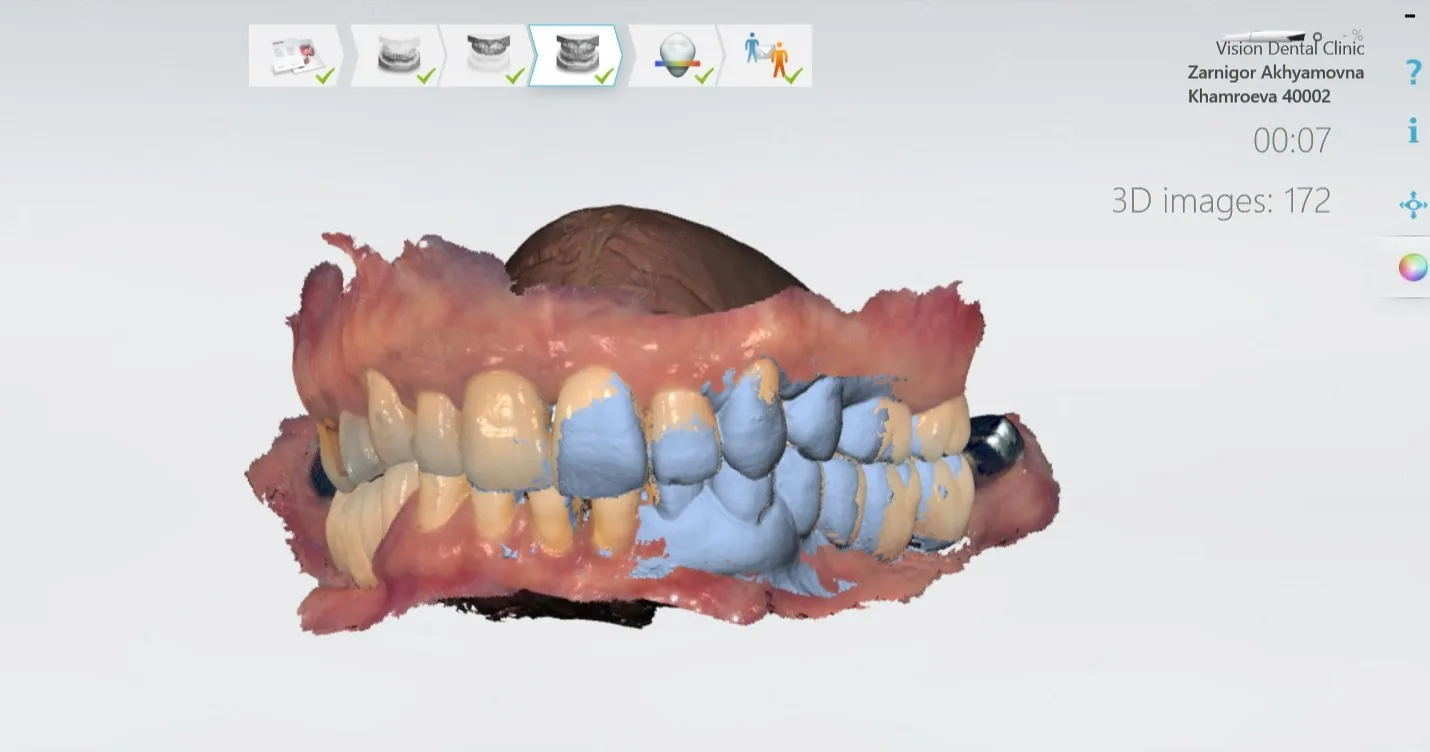 3Shape intraoral scanner — digital impression for full mouth implants Abu Dhabi