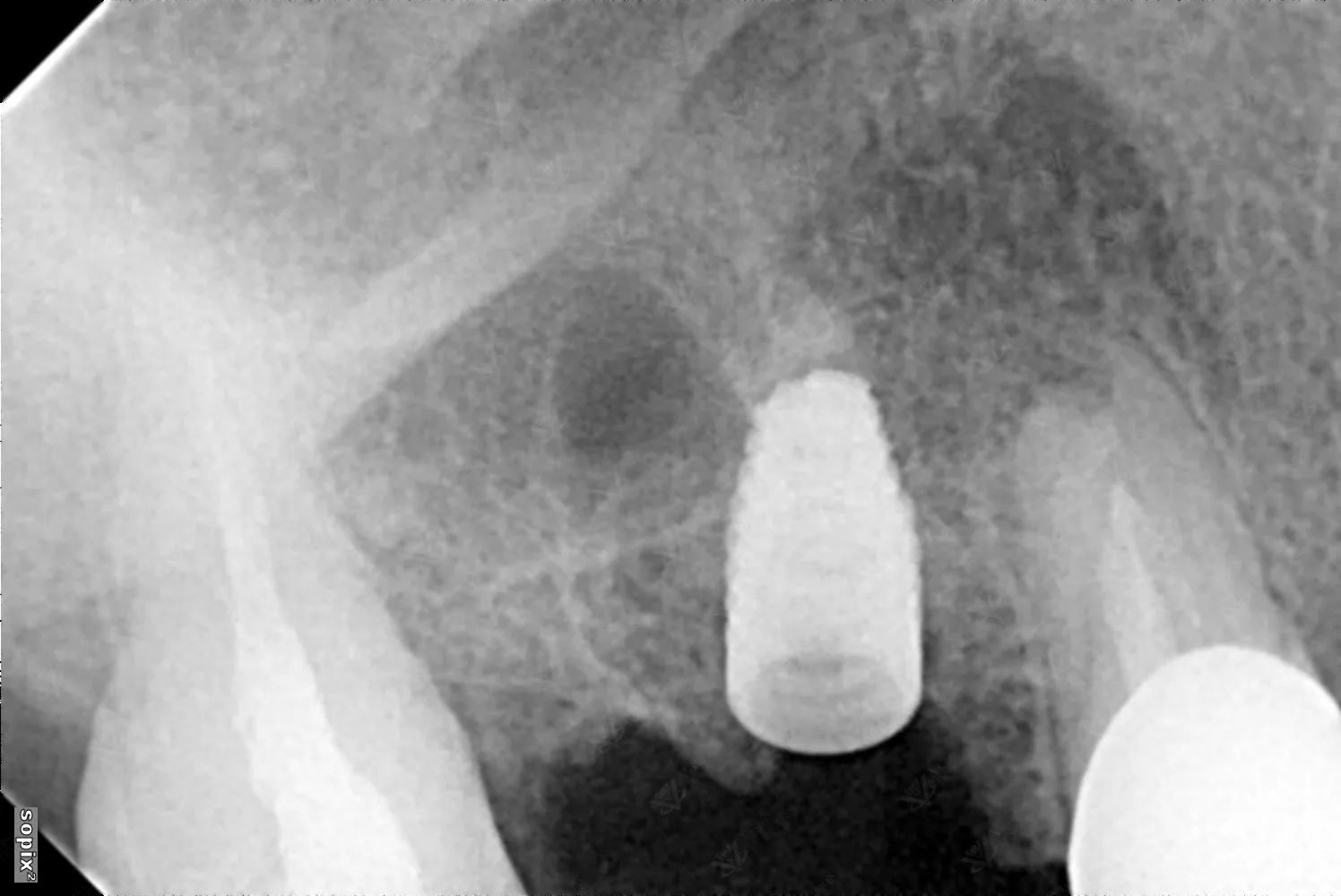 Chairside X-ray — dental implant post-placement verification Abu Dhabi