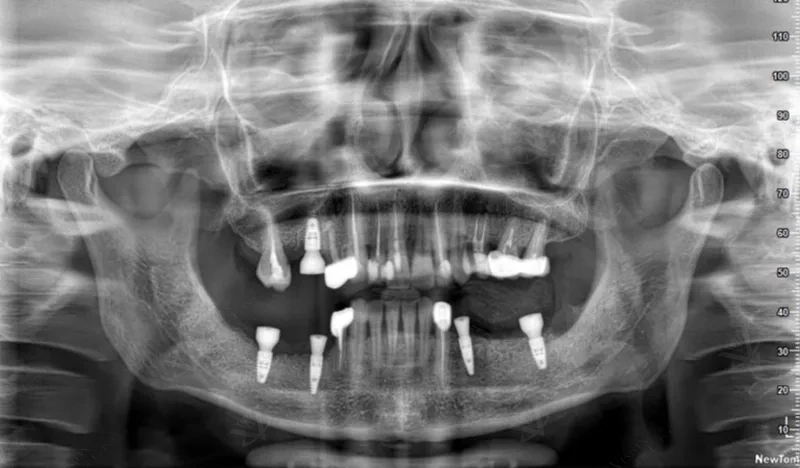 OPG panoramic scan showing dental implant rehabilitation at Vision Dental Abu Dhabi
