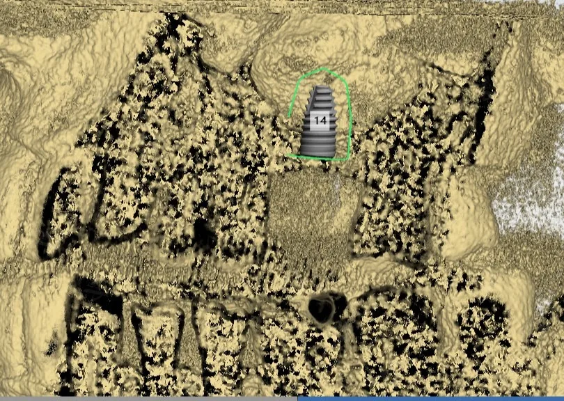 CBCT scan for sinus lift bone augmentation and implant planning