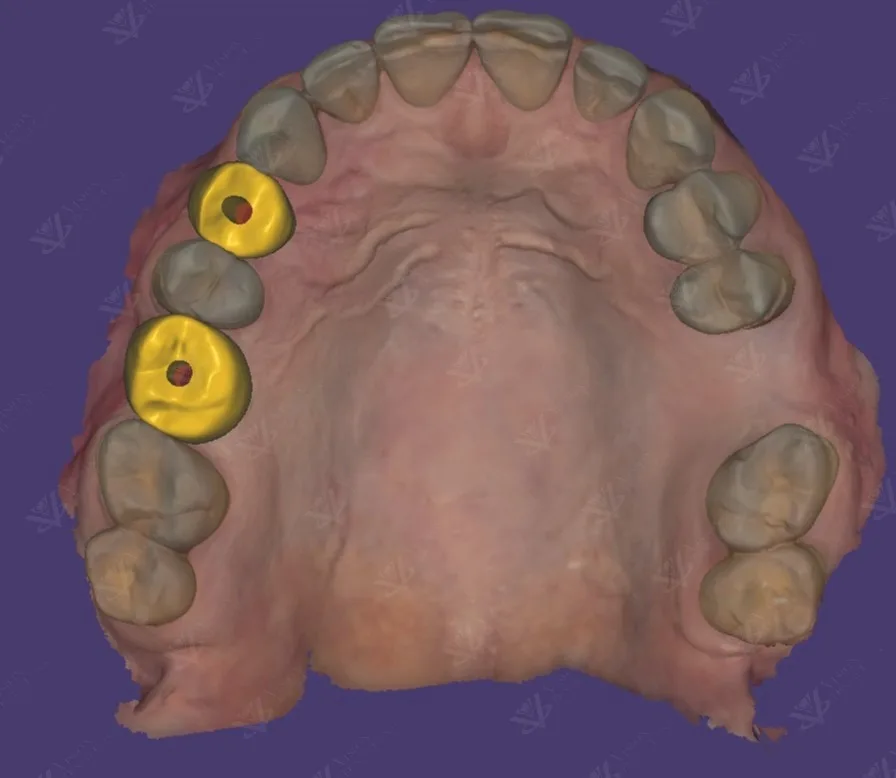 Digital implant planning — occlusal view with planned dental restorations Abu Dhabi