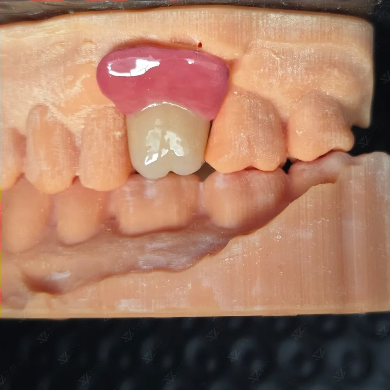 Custom prosthetic crown on dental implant model — implant restoration Abu Dhabi