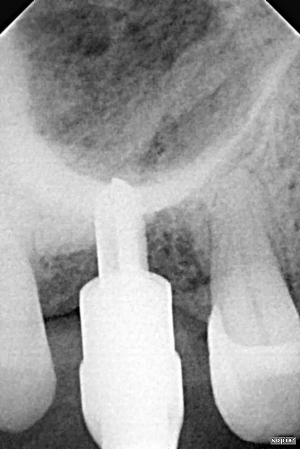 Chairside X-ray — dental implant with abutment verification Abu Dhabi