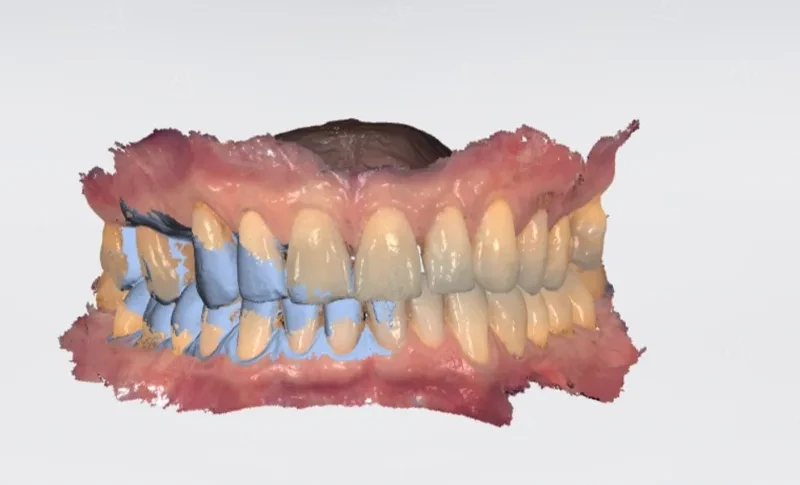 3Shape intraoral digital scan for sinus lift and implant treatment planning