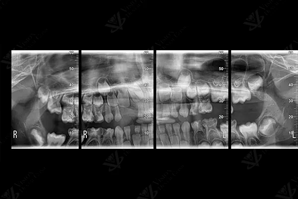 OPG panoramic X-ray for pediatric pulpectomy diagnosis at Vision Dental Clinic Abu Dhabi