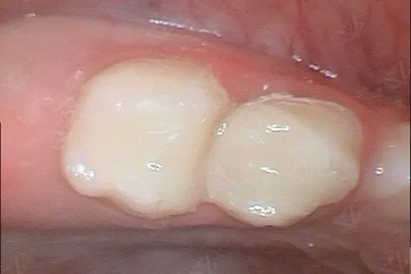 After pulpectomy — fully restored primary molars