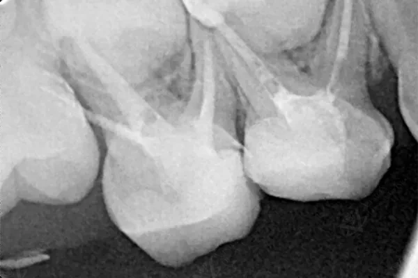 Post-operative X-ray showing successful pulpectomy and restoration