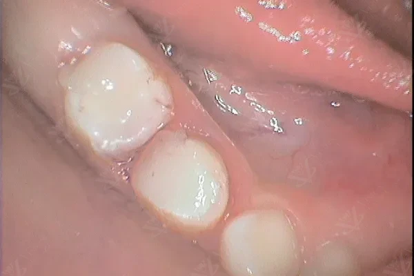 Before pulpectomy — decayed primary molar in pediatric patient