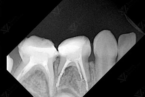 Periapical X-ray confirming successful pulpectomy root canal filling