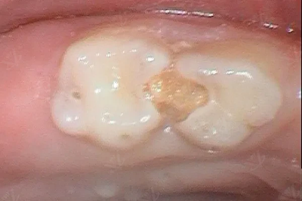 Temporary composite restoration after pulpectomy procedure