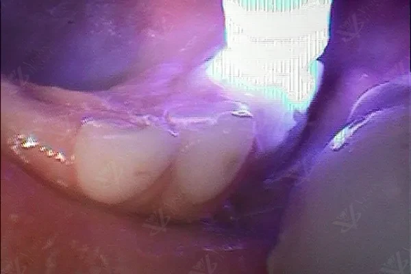 Light curing composite restoration during pediatric pulpectomy