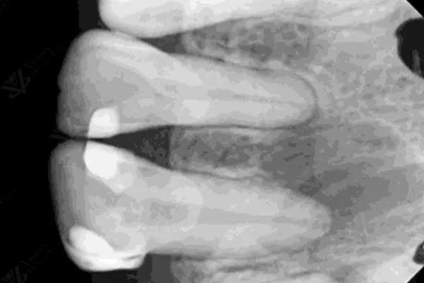 Periapical X-ray showing endodontic case Abu Dhabi
