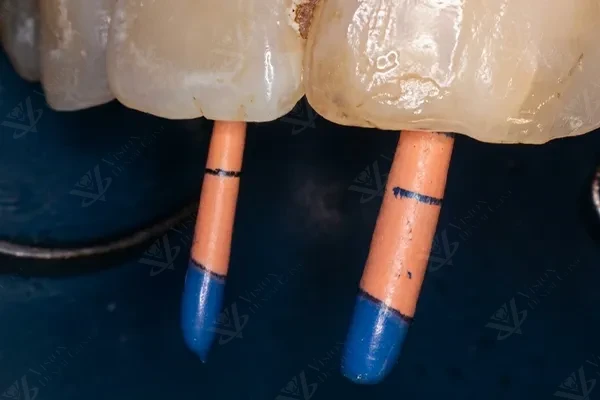 Fiber post placement after root canal Abu Dhabi