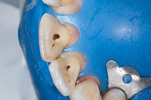 Rubber dam isolation during root canal treatment Abu Dhabi