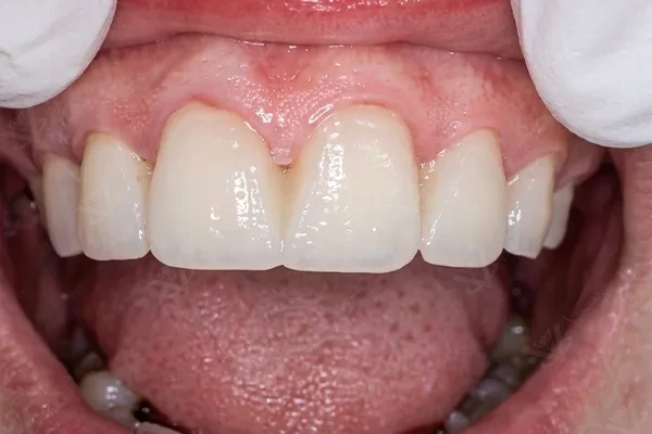 After endodontic restoration and tooth whitening Abu Dhabi