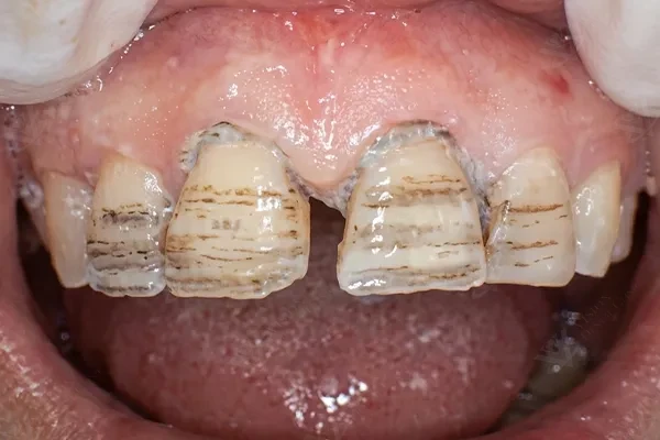 Before endodontic treatment discolored teeth Abu Dhabi