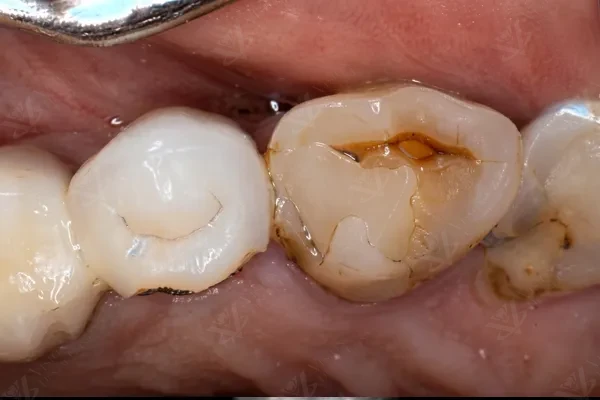 Before full-mouth restoration — damaged teeth with caries