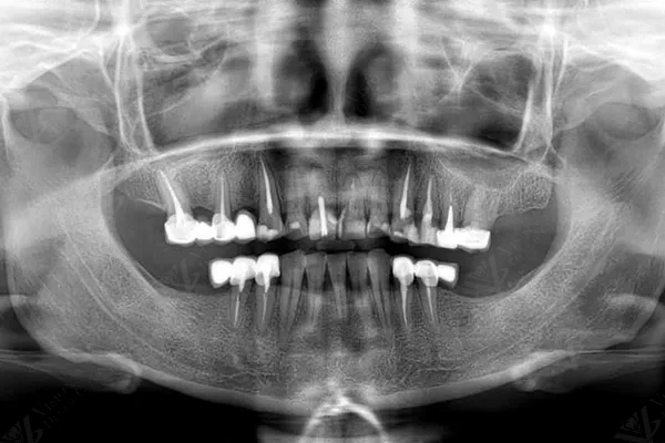 Before — OPG panoramic X-ray