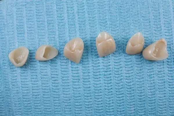 During treatment — porcelain crowns