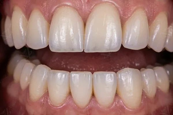 Full-mouth rehabilitation with dental implants and prosthetic crowns Abu Dhabi