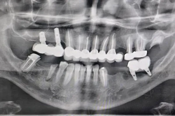 Before — OPG panoramic X-ray