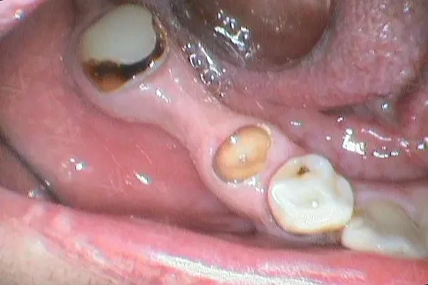 Before — damaged posterior teeth