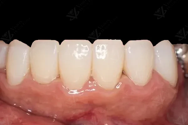 Restorative Rehabilitation — lower anterior restorations
