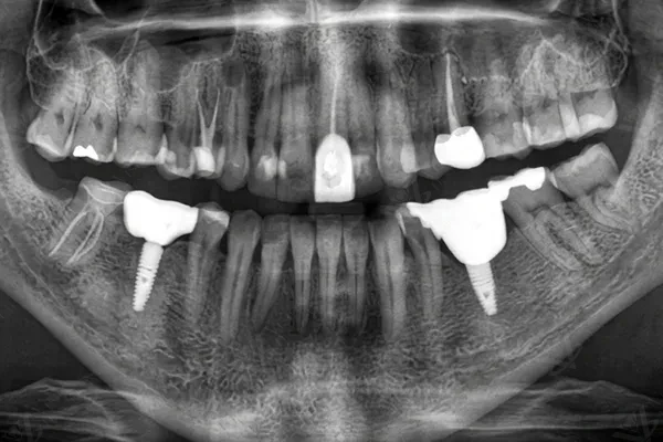 Before — OPG panoramic X-ray