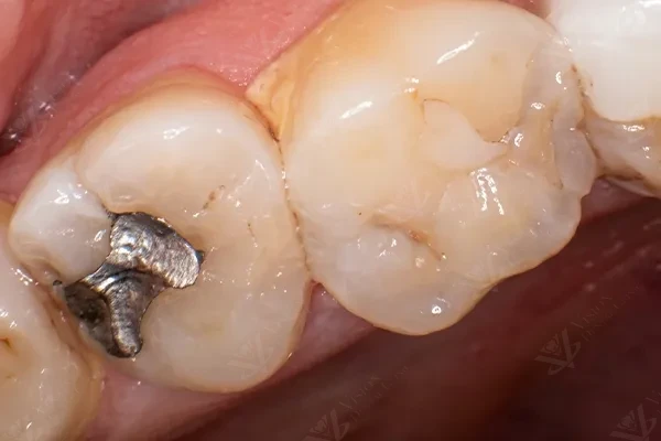 Before — old amalgam filling