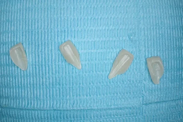 During treatment — veneer prosthetics