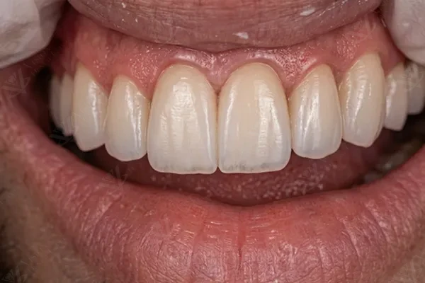 After — final smile result
