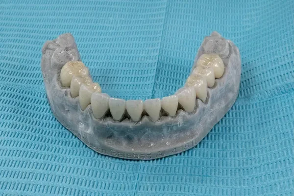 Smile Rehabilitation with Veneers