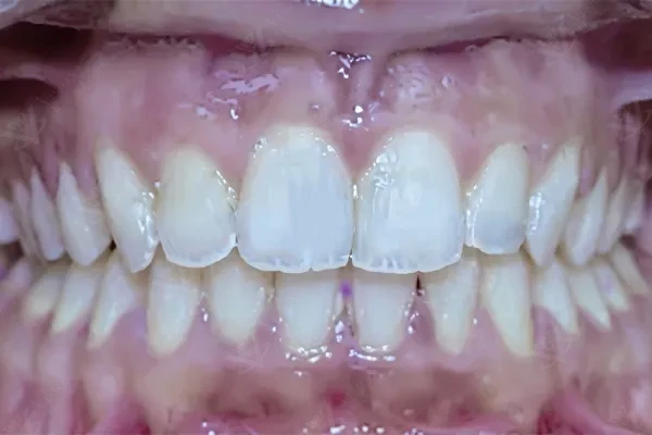 After orthodontic treatment aligned smile Abu Dhabi
