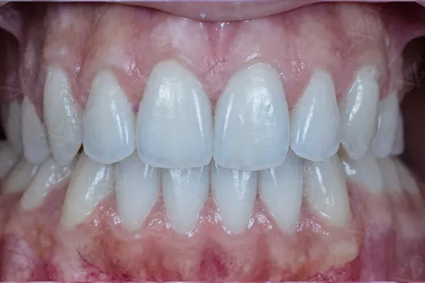 After orthodontic bite correction Abu Dhabi