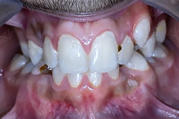 Before orthodontic treatment open bite Abu Dhabi